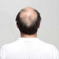 Hair transplant in Riyadh