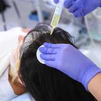 PRP Hair Treatment in Riyadh