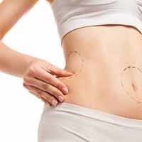 Liposuction in Riyadh